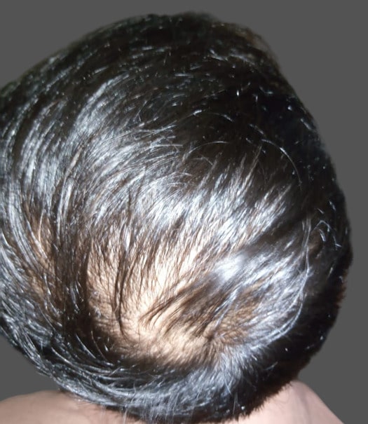 Crown hair loss Karachi patient