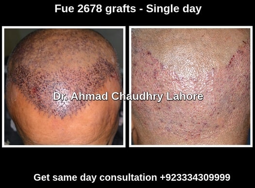 Fue 2678 grafts Lahore