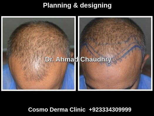 Fue hair transplant Lahore patient