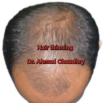 Hair thinning and hair loss before