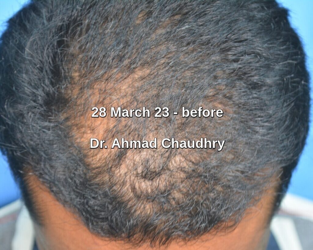 Hair thinning treatment for men in Lahore before
