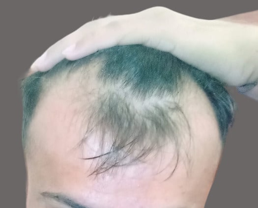 Hair transplant Karachi Pakistan