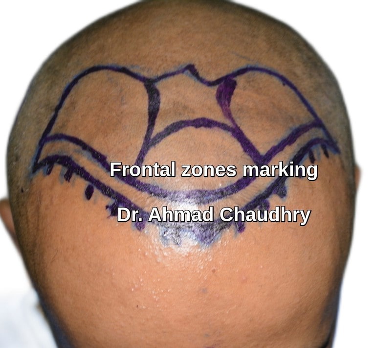 Hair transplant Pakistan patient marking bald area