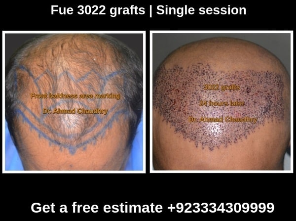 Hair transplant in Lahore