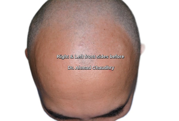 Hair transplant lake city Lahore