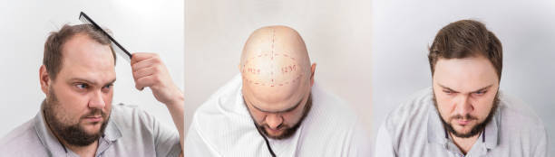 Surgery for hair transplantation