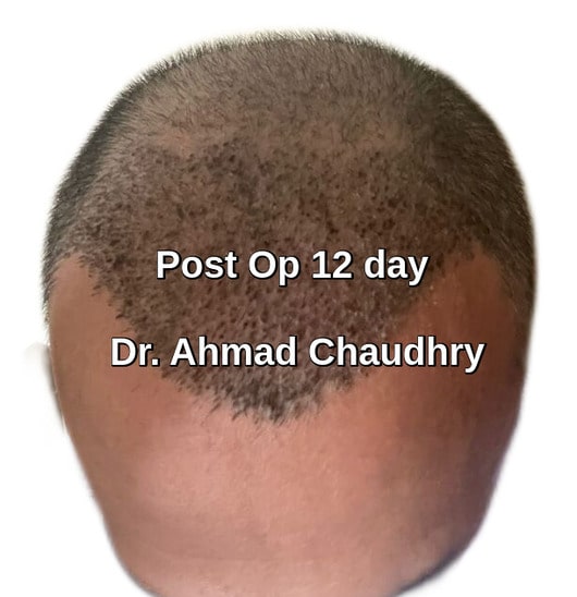 Fue hair transplant lake city 12th day