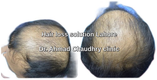 Hair loss solution hair transplant clinic Lahore