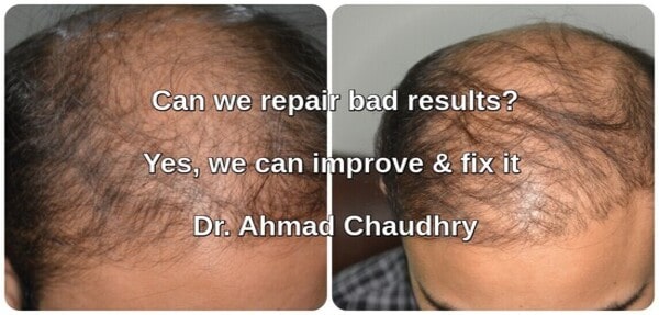 Hair transplant surgery clinic Lahore repair procedure