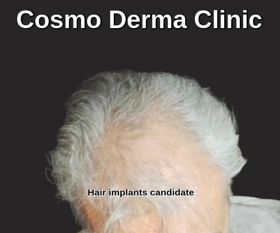 Male hair implants Lahore