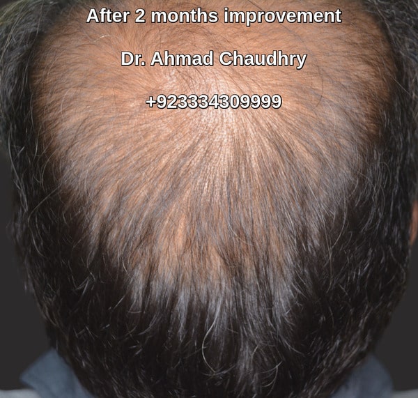 Stem cells hair regrowth results two months