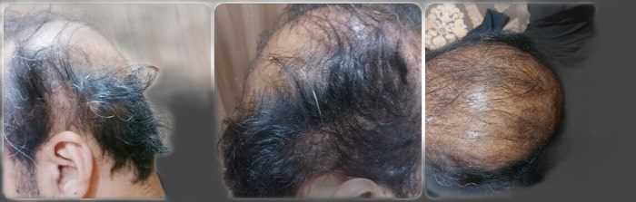 Bad hair transplant Peshawar Pakistan