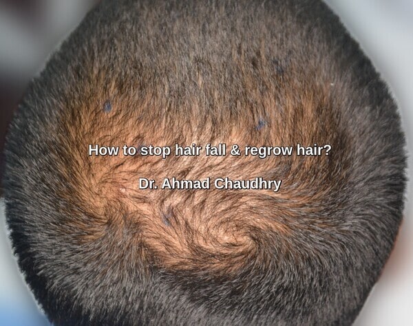 Hair loss- hair transplant Mandi Bahauddin