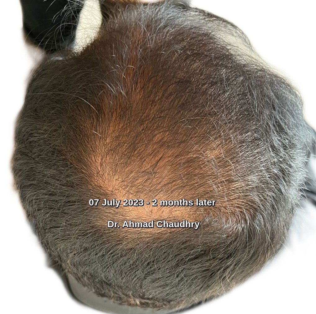 Hair regrowth results Lahore Pakistan
