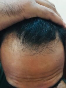 Hair surgery Peshawar