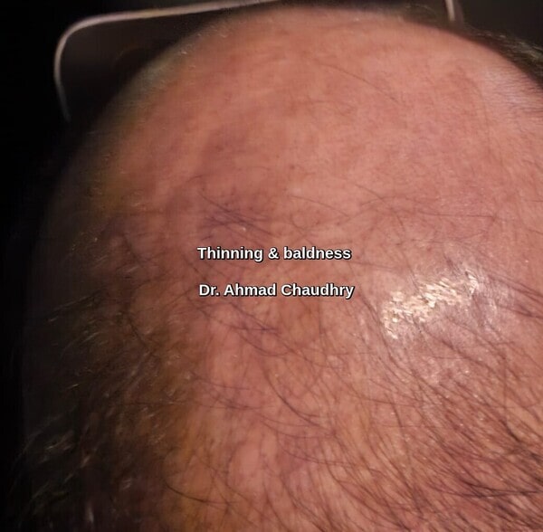 Hair transplant Manchester UK patient