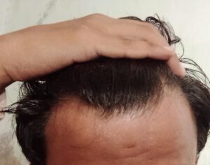 Hair transplant Mirpurkhas