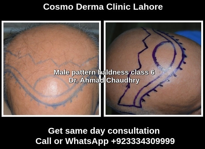 Hair graft replacement Lahore