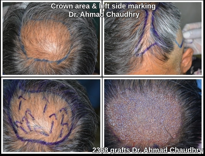 Hair transplant Atlanta