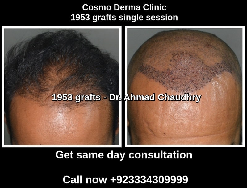 Hair transplant Ivory Coast