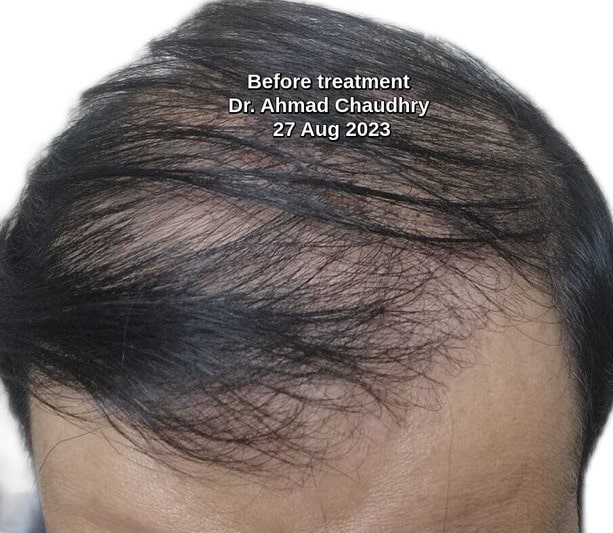 Hair transplant township Lahore patient