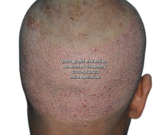 2909 grafts donor area after extraction