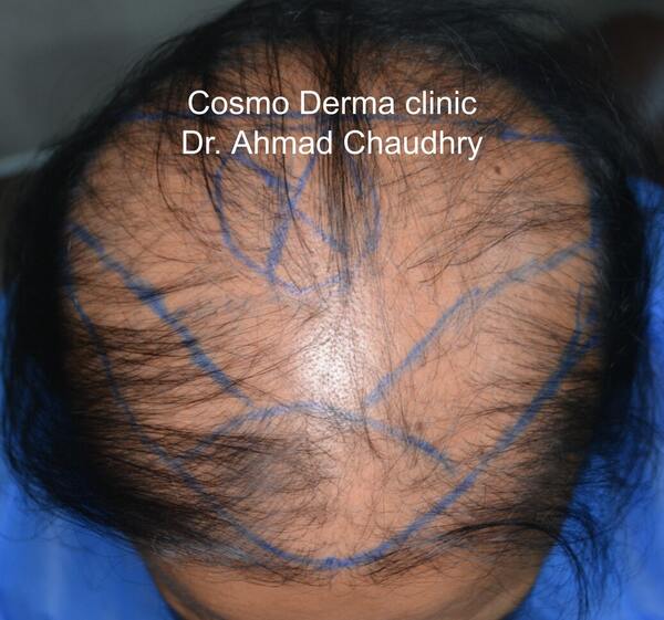 Bald area marking before treatment Muscat patient