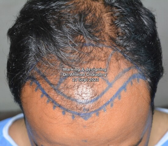 Frontal baldness marking Portugal patient