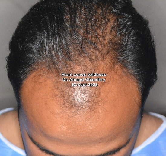 Hair loss Lisbon patient