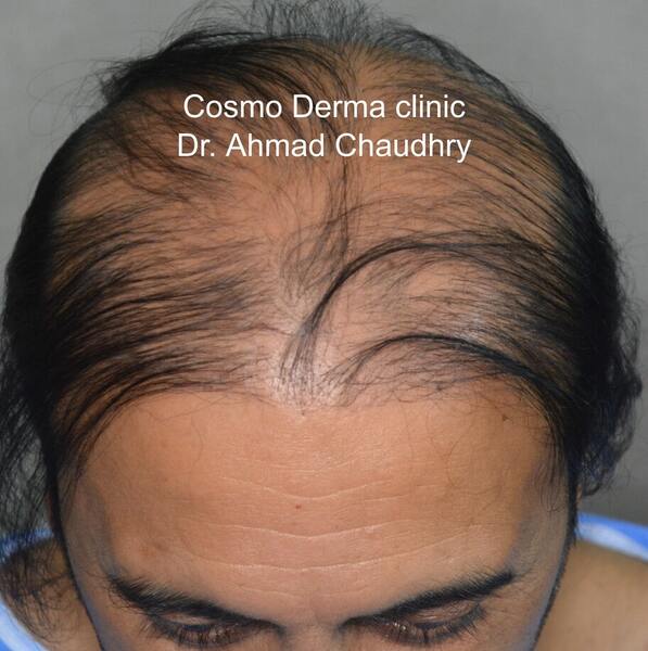 Hair loss before condition
