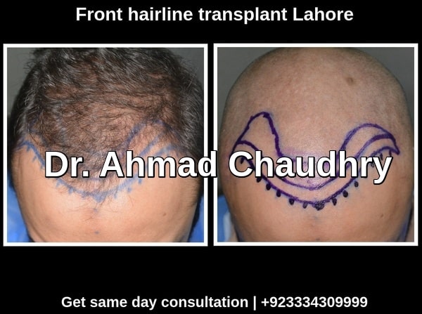 Hair loss transplant Lahore