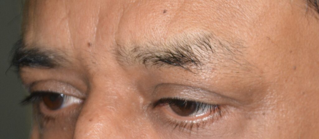 Hair restoration eyes Gujrat patient