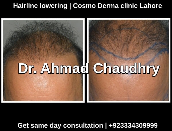 Hair transplant London UK patient