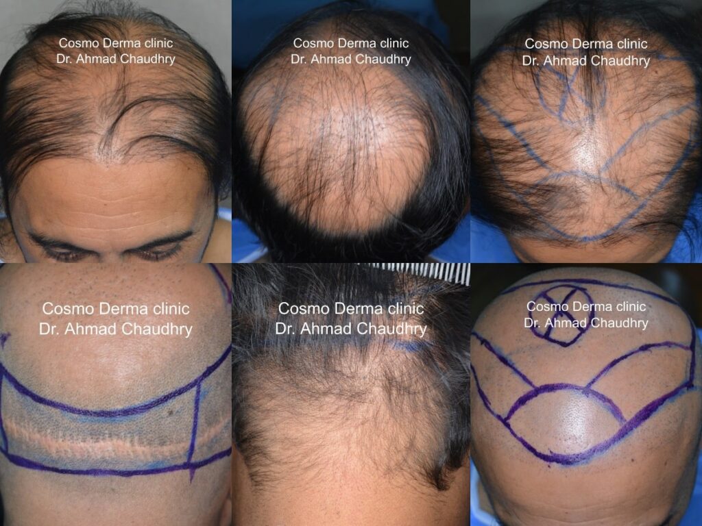 Hair transplant Muscat Oman patient