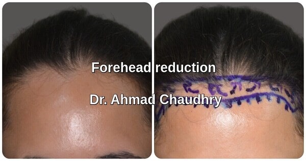 Hair transplant Women Lahore