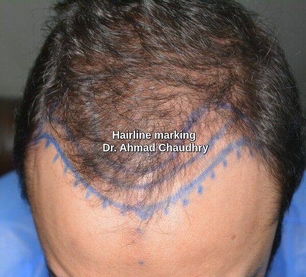 Hair transplant day by day Lahore before