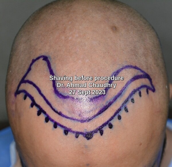 surgical marking before procedure