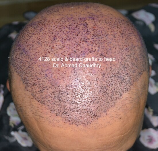 Fue hair transplant Muscat Oman