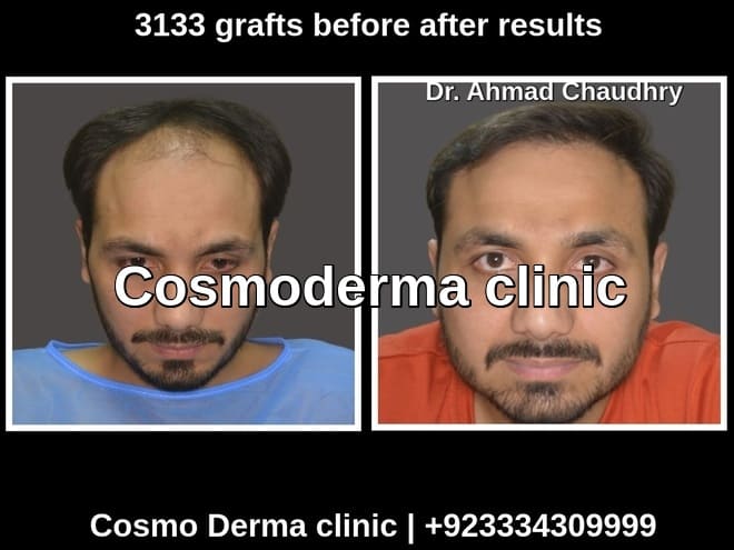 3133 grafts before after result Dr Ahmad Chaudhry