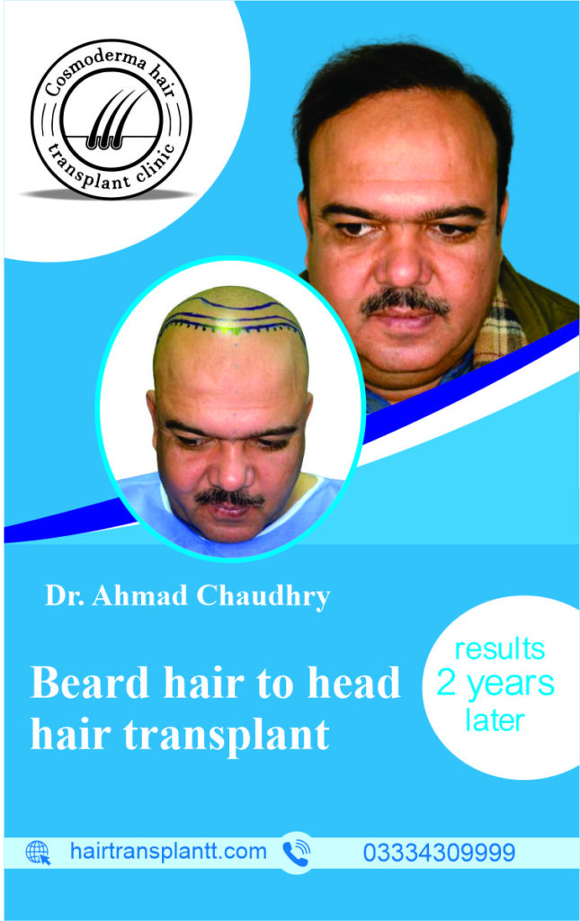 cheap hair transplant uae Dubai