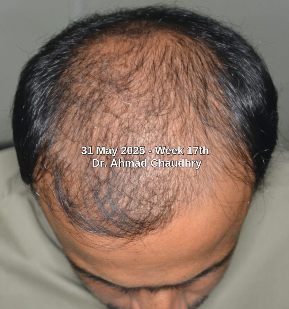 Hair loss can be reversed 